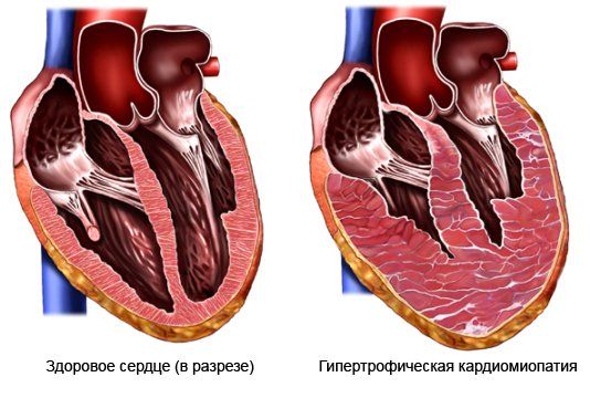 гипертрофия сердца