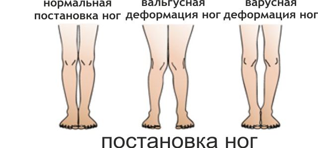 Виды деформации ног человека